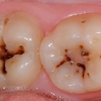 Antes y después dental