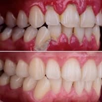 Prótesis dental